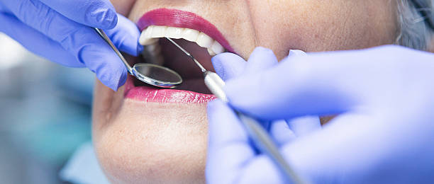 Best Knocked-Out Tooth (Avulsed Tooth) Treatment in Holly Hill, SC